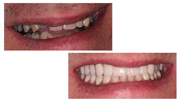 Stamford Dental Group, LLC | Overview, Crowns  amp  Bridges Prosthodontics and Cosmetic Dentistry Restorative Dentistry