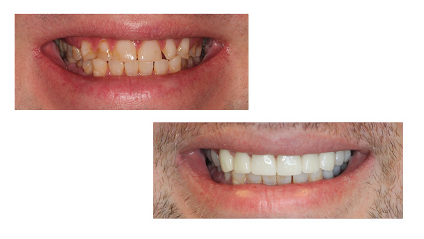 Stamford Dental Group, LLC | Smile In One Day, Early Detection and Prevention and Laser Dentistry Periodontal Care