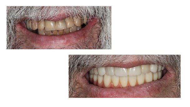 Stamford Dental Group, LLC | Older Adults  amp  Geriatric Patients, Crowns  amp  Bridges Prosthodontics and Early Detection and Prevention