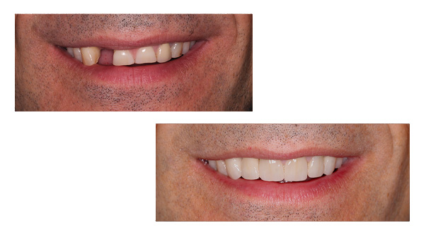 Stamford Dental Group, LLC | Crowns  amp  Bridges Prosthodontics, Intra-Oral Scanner and Early Detection and Prevention