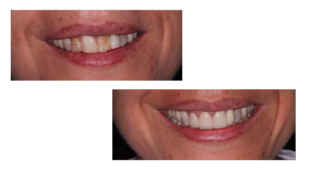 Stamford Dental Group, LLC | Intra-Oral Scanner, Overview and Crowns  amp  Bridges Prosthodontics